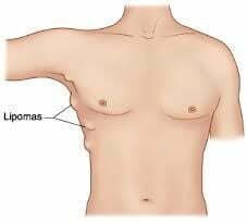 Lipomas in the body