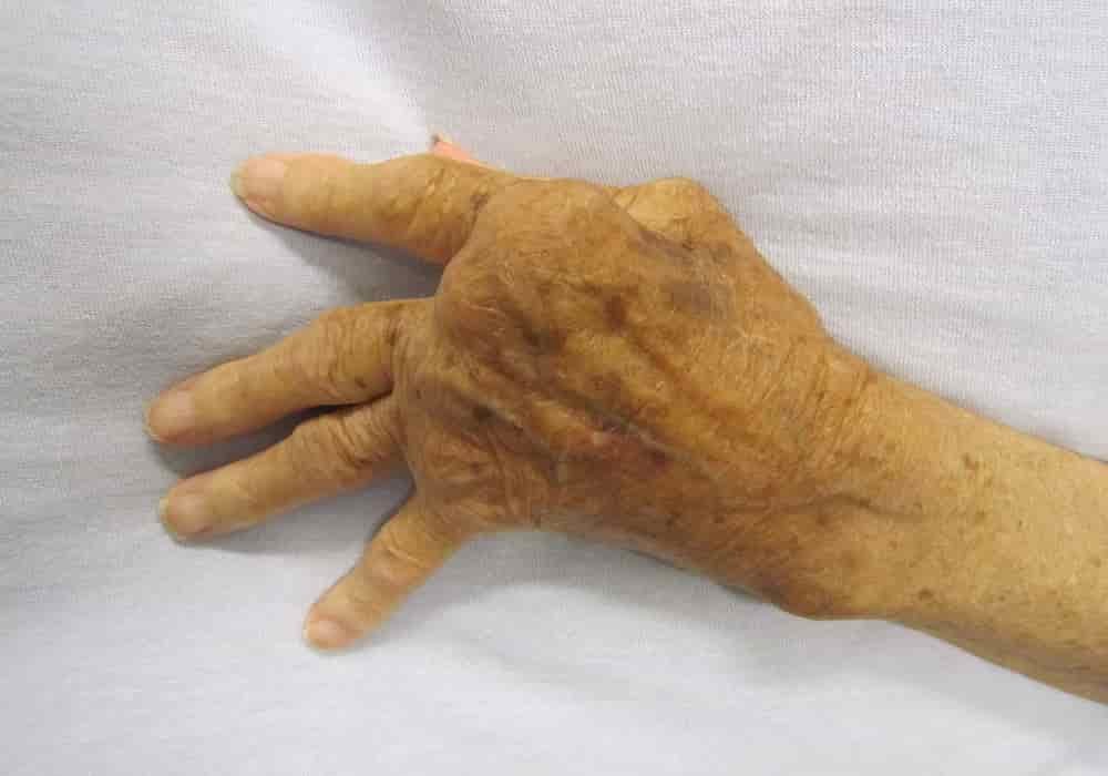 Rheumatism or Arthritis Rheumatoid Arthritis