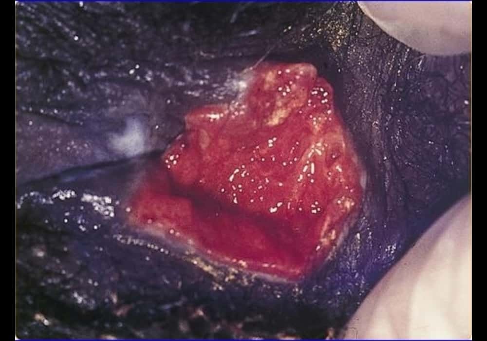 Granuloma inguinale (Donovanosis) ulcer in the vagina