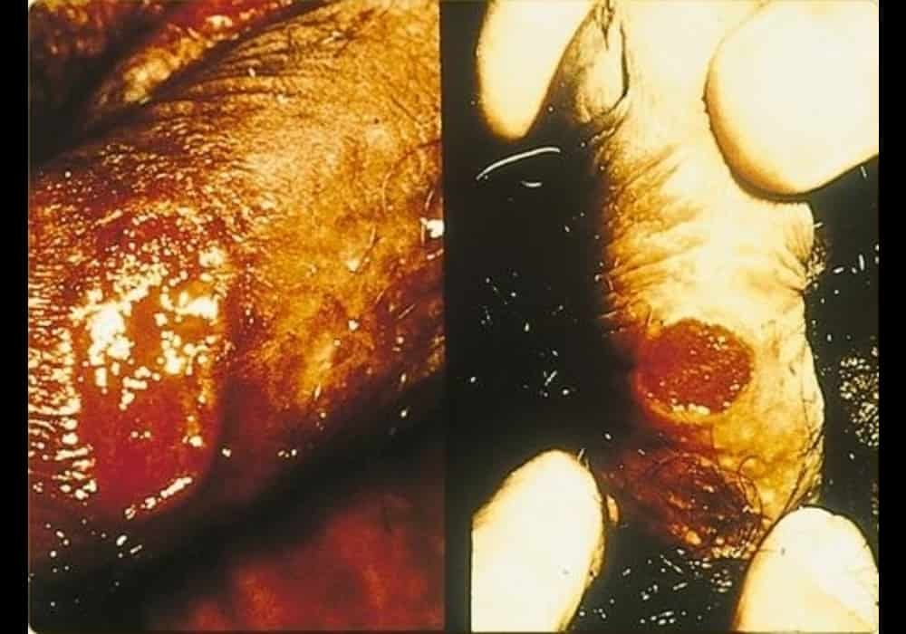 Ulcer developed as a granuloma inguinale (Donovanosis) in the penis