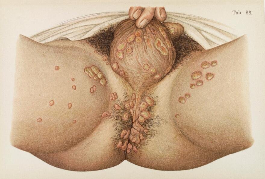 Illustration showing skin of the scrotum and perineum area diseased with syphilis