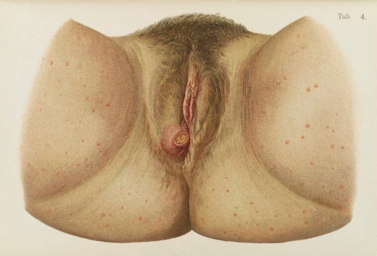 Labia diseased with Syphilis
