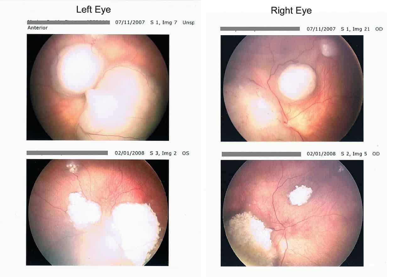 Retinoblastoma retinal cancer