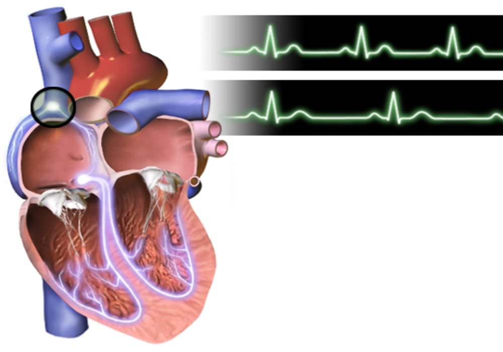 Bradycardia slow heart rate