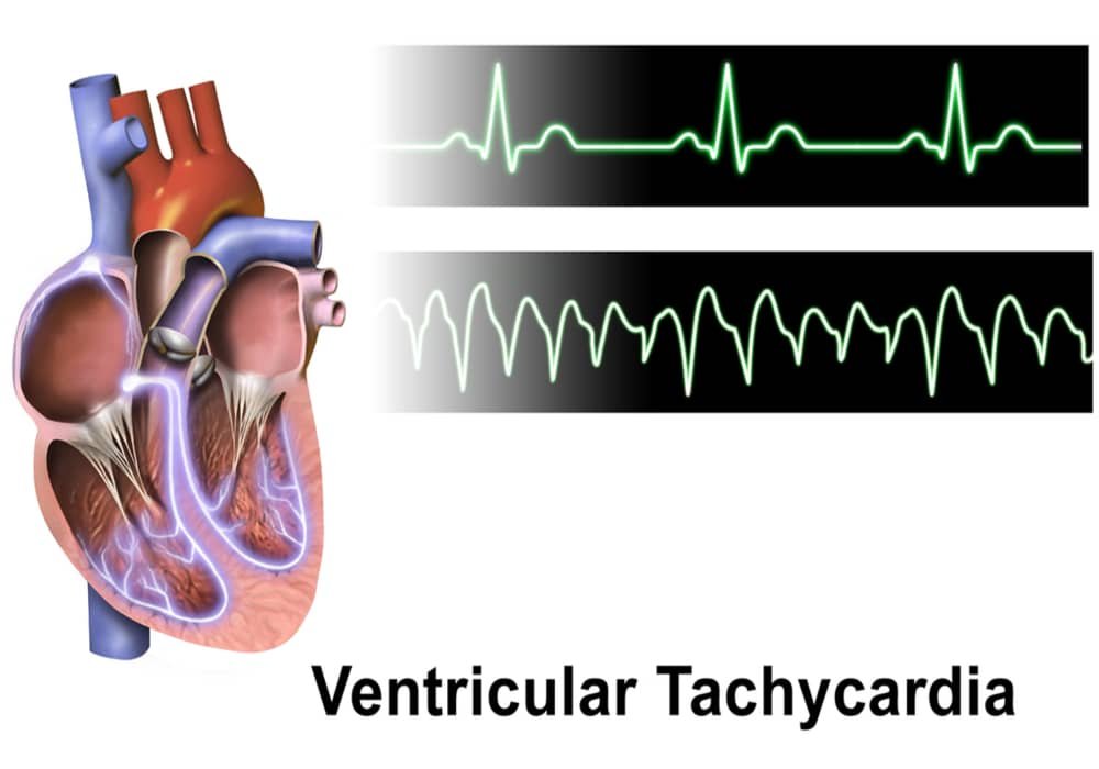 Tachycardia fast heartbeat at rest | Symptoms, Diagnostics, Causes and Treatment