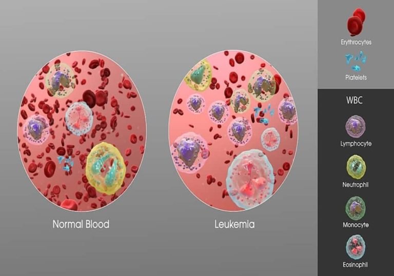 Leukemia Symptoms, Stages, Chances of Surviving, Treatments