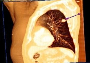 Lung cancer carcinoma