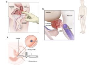 Prostate cancer