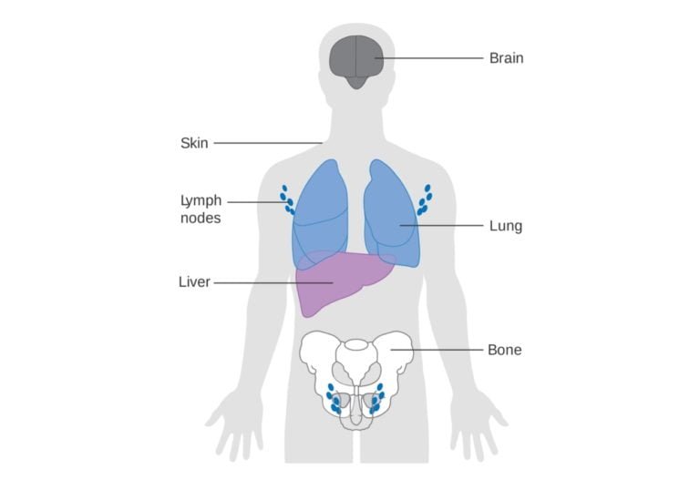 Types of Cancer | Adult, Children, Head, Neck, Digestive, Blood