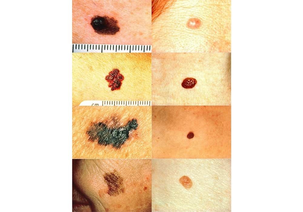 Melanoma Skin Cancer Face