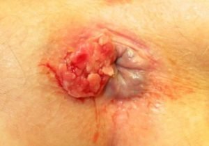 Anal Cancer (Anus) | Symptoms, Stages, Types, Diagnoses, Chances of Surviving, Treatments