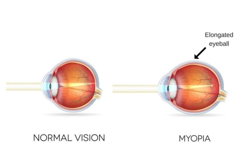 Myopia (Near-sightedness and Different Types of Myopia