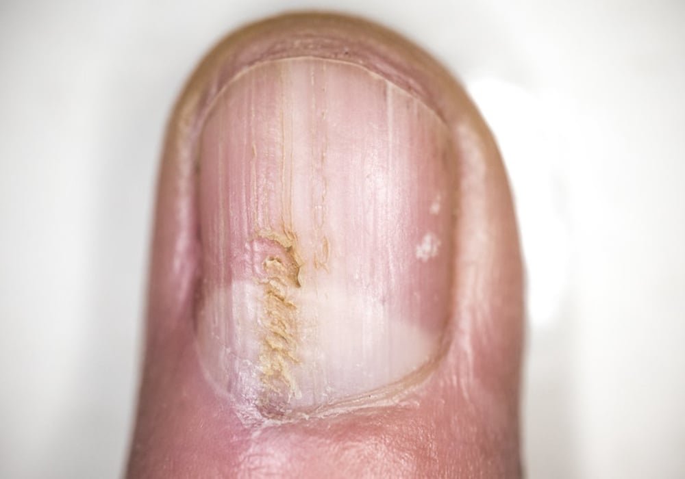 Nail fungal infection