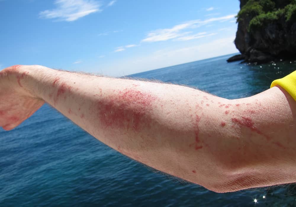 Stung by Jellyfish | What to do if you get stung by it?