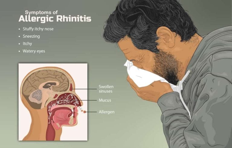 allergic-rhinitis-medizzy