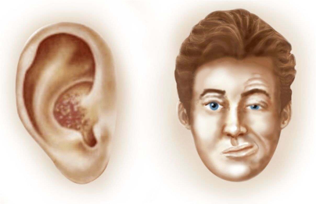 Ramsay Hunt Syndrome (herpes zoster oticus) affects the facial nerve near one of ears