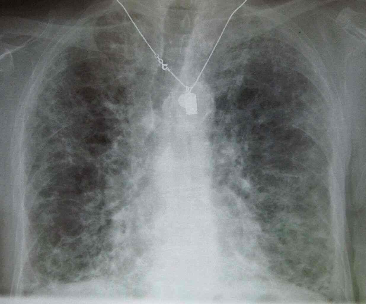 Pulmonary Fibrosis | Definition, Symptoms, Diagnosis and Treatments