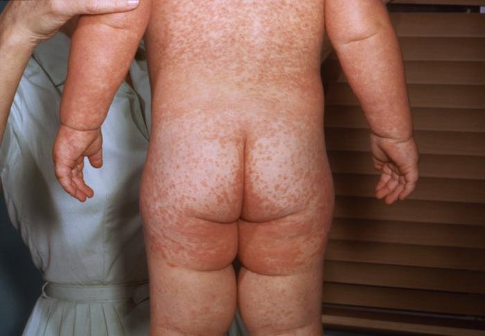 Measles rash rubeola